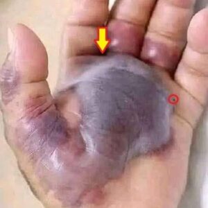Doctors Are Warning Everyone This Small Bite Turned a Hand Black, And It Could Happen to Anyone