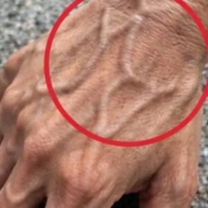 If Someone Has Visible Veins, Does It Mean Their Circulation Is Poor?