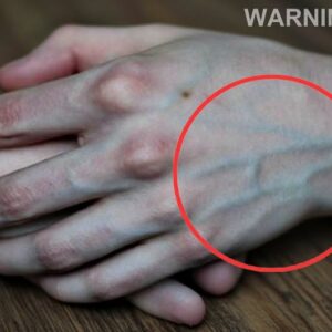 If your veins are visible in your hand, it is a signal of ca…
