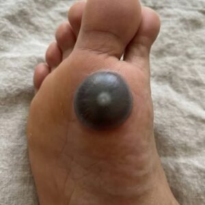 My daughter woke up with this huge spot on her foot I don’t know what it could be. She’s been in pain and can’t move her foot what is this..