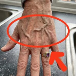 Visible Veins Explained! Normal Causes, Health Risks, and When to Worry
