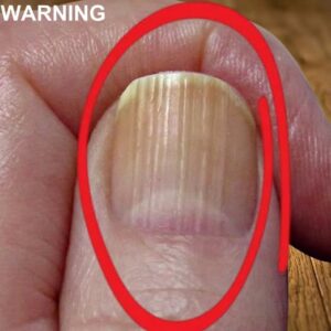 If you have lines on your nails, it means you have ca..