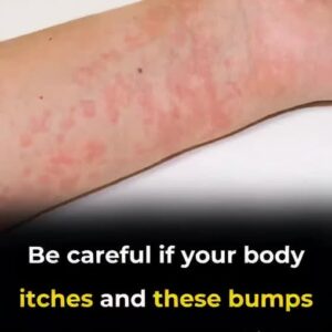 What’s really causing your hives? Uncover these unexpected triggers