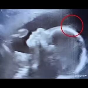 Doctors couldn’t believe what they saw during the ultrasound