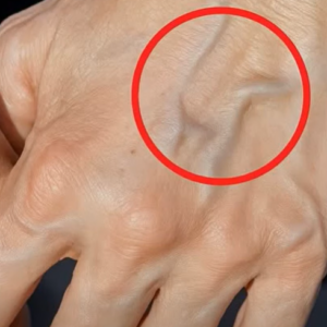When to Worry About Veins That Appear Out of Nowhere