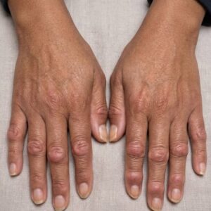 Those Hard Knots Near Your Fingernails May Not Be “Just Aging”…